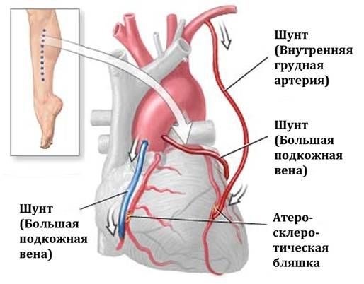 Длительность госпитализации после операции шунтирования сердца