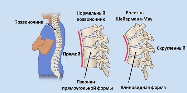 Что такое болезнь Шейрмана-Мау?