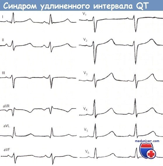 Синдром удлиненного QT: причины, симптомы, последствия